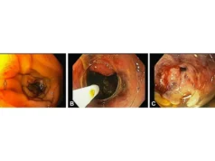 使用三種先進的內窺鏡技術治癒了危及生命的十二指腸損傷