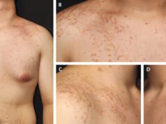 奇怪的、發癢的皮疹與生酮飲食有關,但沒有人知道為什麼