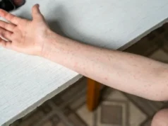 美國一所大學面臨近代史上最大規模的麻疹疫情 – 沙烏地阿拉伯新聞