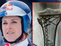 林賽·沃恩 (Lindsey Vonn) 在最近的手術後“掙扎”,目前仍在美國醫院接受治療