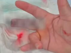 查科暴力襲擊:病人撕掉護士手指的一部分