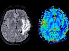 更年期與關鍵大腦區域灰質的喪失有關