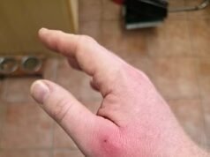 英國最危險的蜘蛛再次襲擊:一名男子被「保齡球大小」的食肉動物咬傷住院,專家警告假寡婦正在英國各地迅速蔓延