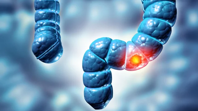 colon-colorectal-cancer.webp.webp
