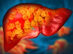 梅奧診所發現一種導致脂肪肝疾病的罕見基因突變