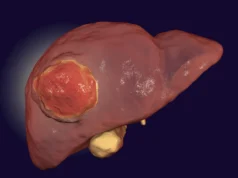 一項研究發現,少吃蛋白質可能會減緩肝癌的生長