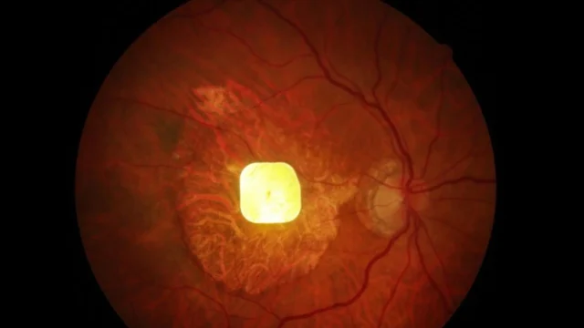 vision-chip-in-patients-eye.webp.webp