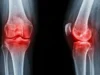 科學家發現了一種無需藥物或手術即可緩解關節炎疼痛的簡單方法