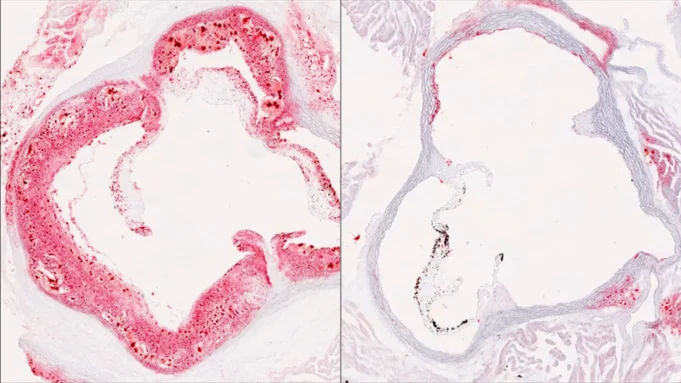 cholesterol-ldlr-helz2-atherosclerotic-plaque.webp