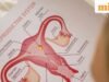 PCOS 將被稱為 PMOS,因為專家表示舊名稱會導致混亂和護理延誤