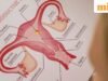 PMOS 或 PCOS 不僅與荷爾蒙有關:以下是專家希望女性了解的生活方式因素